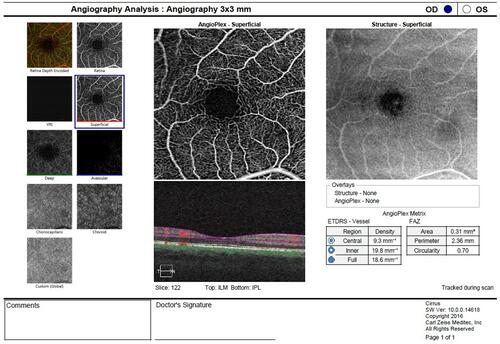 Figure 1 3x3 scan of foveal avascular zone of a representative case is seen.