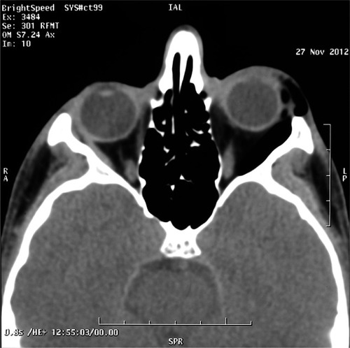 Figure 2 Left lower lid subcutaneous emphysema, lateral subconjunctival emphysema, and orbital emphysema.