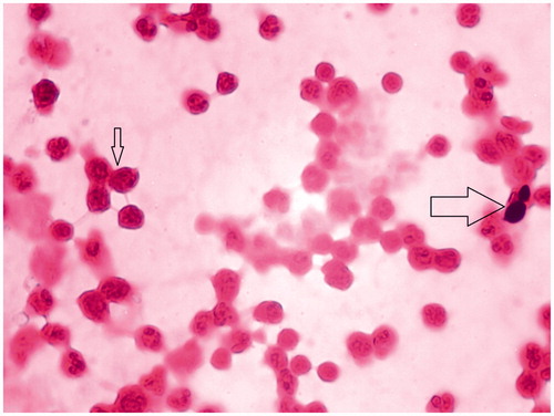 Figure 1. Intracellular budding yeast cells (big arrow) with polymorphonuclear leucocytes (small arrow) on Gram stain of the dialysate.