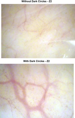 Figure 5 Example videocapillaroscopy images from subjects with and without dark circles showing visual differences in the vascular network.