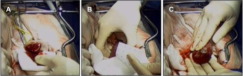 Figure 4 HEMOPATCH (Sealing Hemostat) is applied to a partial nephrectomy in a swine.