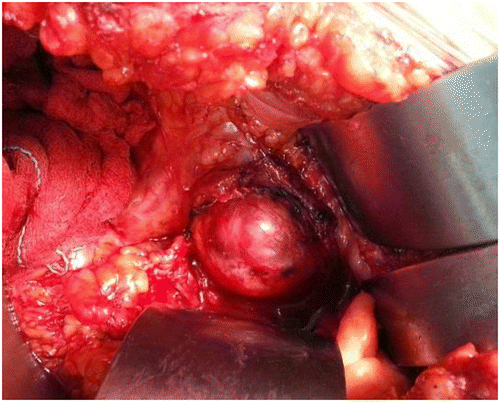 Figure 1: Intraoperative image showing a left pelvic mass adherent to the iliac vessels.