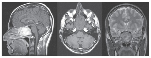 Figure 1 Sagittal, axial, and coronal magnetic resonance images showing a large giant cell tumor originating from the clivus and involving both cavernous sinuses.