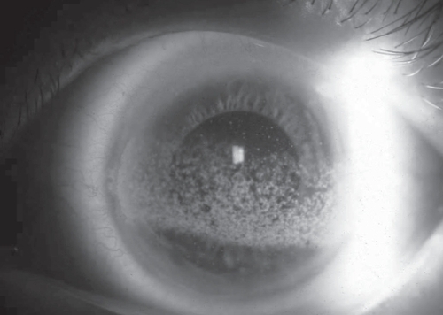 Figure 1 Band keratopathy in the setting of intraocular inflammation and elevated serum calcium.