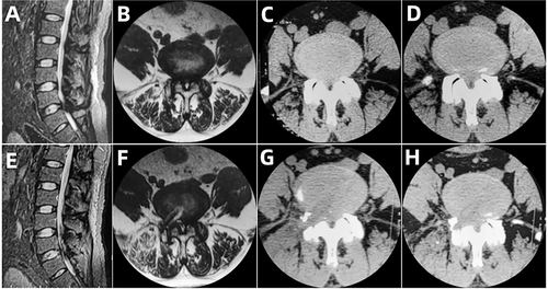 Figure 4 Pre- and postoperative CT and MRI of PTED. (A–D) Preoperative CT and MRI showing LSS. (E–H) Postoperative CT and MRI showing lateral recess enlargement.