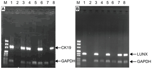 Figure 3 The expression of CK19 mRNA and LUNX mRNA from PBMCs in NSCLC patients. (A): CK19; (B): LUNX (M: DNA marker: Lane 1: Lung cancer tissues; Lane 2: Blank control; Lanes 3–8: NSCLC patients).Abbreviations: PBMCs, peripheral blood mononuclear cells; NSCLC, non-small cell lung cancer; GAPDH, glyceraldehyde-3-phosphate dehydrogenase; LUNX, lung specific X protein; CK, cytokeratin.
