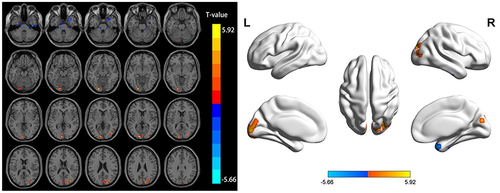 Figure 2 Differential brain regions of ALFF in the slow-4 band between the AP and HC groups.
