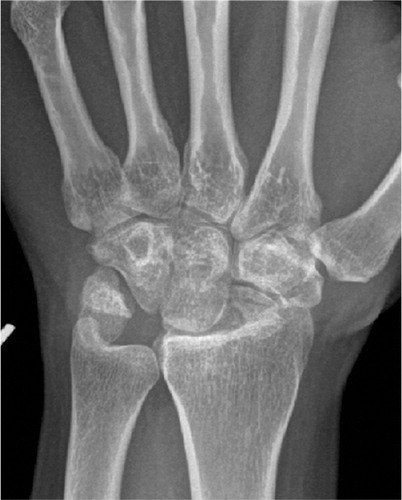 Figure 6. Proximal row carpectomy. Follow-up after 2 years.