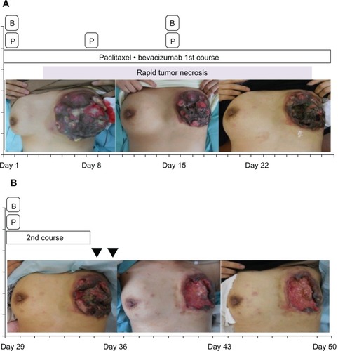 Figure 2 The patient’s clinical course after administration of paclitaxel and bevacizumab combination therapy.