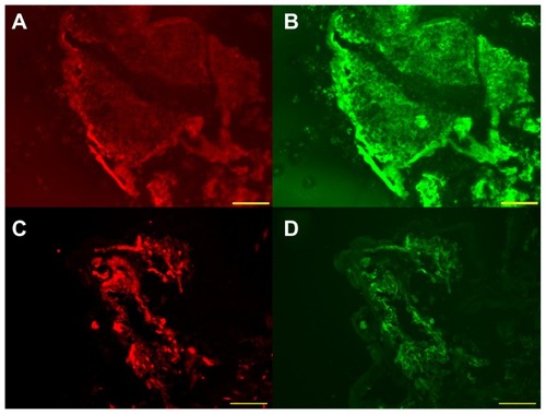 Figure 4 Immunoreactivity of biopsy sample of retinal tumor for vimentin (A), glial fibrillary acidic protein (B), neuron-specific enolase, (C), and vascular endothelial growth factor (D).