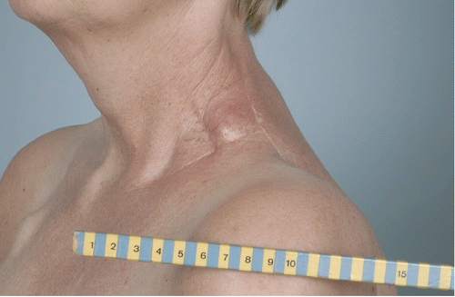 Figure 11. Local supraclavicular schwannoma recurrence.