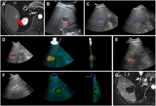 Figure 4. A 58-year-old male with hepatocellular carcinoma in segment VI of liver. (A) Preoperative MRI showed one HCC lesion in segment VI with diameter measured to be 2.1 cm. (B) In baseline ultrasound, the lesion appeared hypoechoic. (C) Tumor (in green color) and ablative margin (in purple color) were labeled in 3DUS reconstructive image (right) and projected to real-time 2DUS image (left). (D) With adjustment of the puncture path, angle, and depth, two needles were planned to be placed to ensured complete ablation. (E) During the needle placement process, the labels of lesion and ablative margin could be hidden in real-time 2DUS image if needed. The red arrows showed the tip of two ablation needles. (F) The tumor and ablative margin were completely covered by the hyperechoic ablation zone (left), and the scanning plane could be displayed in three-dimensional way to assist comprehensive assessment (middle and right). (G) MRI at one month after ablation showed complete ablation of the tumor with ablative margin greater than 5 mm.
