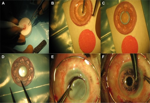 Figure 4 Assembly and implantation of Boston type-1 KPro.