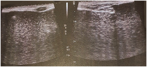 Figure 3. Breast ultrasound, showing diffuse liquid material.