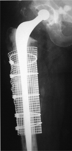 Figure 6. Long-stem impaction revision for the treatment of the nonunited fracture demonstrated in Figure 5.