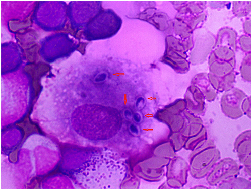 Figure 1 Wright stain finding of bone marrow smear demonstrated intracellular oval budding yeast (red arrows) of Histoplasma capsulatum. (1000 × magnification oil lens).
