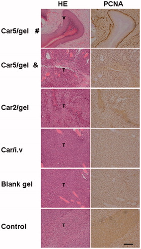 Figure 7. H&E staining and PCNA immunostaining of ex vivo RTs (including tumor) 16 days after tumor inoculation. Bar = 100 μm. T = viable tumor tissue, V = normal vaginal tissue. Car5/gel # = sample without tumor recurrence, Car5/gel & = sample with tumor recurrence.