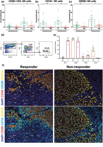 Figure 2. Quantitative multiplex fluorescent image analysis of NK cells in baseline FFPE and NK cell phenotyping by flow cytometry.NK cell phenotype and activation were evaluated on baseline FFPE tissue biopsies in 12 responding (R) and 13 non-responding (NR) stage IV melanoma patients treated with anti-PD-1 therapy (a) Intratumoral vs. peritumoral count of NK cells/mm2 in responders and non-responders. (b) Intratumoral vs. peritumoral count of CD16+ NK cells/mm2 in responders and non-responders. (c) Intratumoral vs. peritumoral count of GRZB+ NK cells/mm2 in responders and non-responders. Tumor dissociates from five stage III melanoma patients were analyzed for CD69, PD-1, CD16 and CD57 expression on NK (orange) and CD8+ (red) T cells. (d) Gating strategy used to identify CD56 + CD3- NK cells and CD3 + CD8 + T cells. (b) PD-1, CD69, CD57 and CD16 expression (%) on NK and CD8 + T cells. (e) PD-1, CD69, CD57 and CD16 expression (%) on NK and CD8 + T cells. (f) Multiplex fluorescent images comparing CD56, CD16 and GRZB staining in responders and non-responders. DAPI represents the nucleus. The arrows represent colocalization of CD56 and CD16 or CD56 and GRZB. Error bars represent the standard error of the mean. P values were obtained by Mann-Whitney U test. *P < 0.03; **P < 0.0021. Error bars represent the standard error of the mean. Abbrev. T: T cells; NK: Natural killer cells.