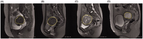 Figure 1. Representative images of uterine fibroids with different signal intensities on T2-weighted sagittal MRI. (A) Hypo-intense; (B) Isointense; (C) Heterogeneous intense and (D) Homogeneous hyper-intense. The yellow marker is the outline of the uterine fibroid.