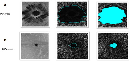 Figure 2. Preoperative (A) and postoperative (B) OCTA of DCP in a patient with FTMH. OCT-A images of DCP demonstrate enlargement of the FAZ area before surgery (A) and reduction in the FAZ area after surgery (B). Note: OCT: optical coherence tomography; OCTA: optical coherence tomography angiography; DCP: deep capillary plexus; FAZ: foveal avascular zone.