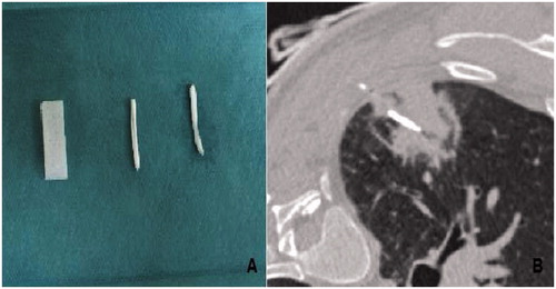 Figure 1. Macroscopic appearance of iodine soaked, waterproof torpedo Curaspon® (CuraMedical), (A) CT of radiofrequency pathway of lung Curaspon torpedoes and CT after implantation of Curaspon torpedoes along the radiofrequency lung pathway (B).