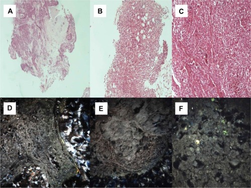 Figure 5 (A) Malt cell lymphoma (microscopic observation 100×). (B) Sarcomatoid mesothelioma (microscopic observation 100×). (C) Epithelioid mesothelioma (microscopic observation 100×). CytoViva® spectral imaging of (D) a malt cell lymphoma, (E) a sarcomatoid mesothelioma, and (F) an epithelioid mesothelioma.