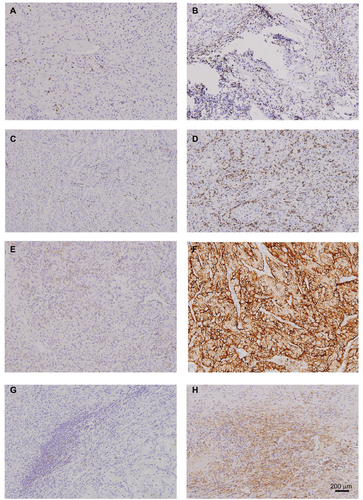 Figure S1 TIL and immune checkpoint expression in mRCC tissues.Notes: CD8 low (A), CD8 high (B), PD-1 low (C), PD-1 high (D), TC PD-L1 negative (E), TC PD-L1 positive (F), TIMC PD-L1 negative (G), TIMC PD-L1 positive (H) in mRCC tissues. Original magnification: ×100.Abbreviations: PD-1, programmed cell death protein 1; PD-L1, ligand of PD-1; mRCC, metastatic renal cell carcinoma; TC, tumor cells; TIMC, tumor infiltrating mononuclear cells; TIL, tumor infiltrating lymphocyte.