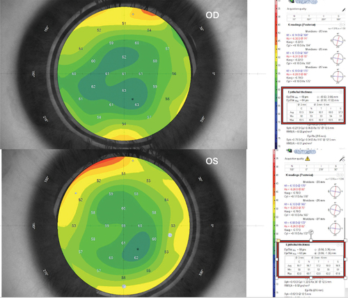 Figure 3. 6-month follow-up epithelial thickness map of the same case in both eyes. The associated table divides the measurement to central 3mm (C) and paracentral nasal (N), temporal (T), inferior (I), and superior (S) 3–6mm annulus. mPRK-treated eye shows slightly increased epithelial thickness than tPRK-treated eye.