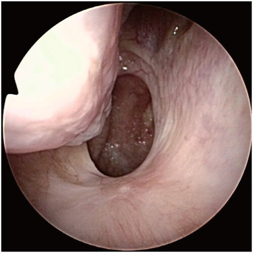 Figure 4. Endoscopic examination 14 months after the surgery showed no recurrence on the nasal floor.