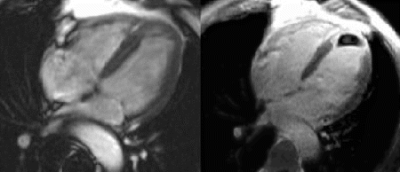 Figure 1. FISP imaging (L) in a patient with an acute MI is inconclusive, but the large thrombus (R) is revealed by early contrast imagine (R).