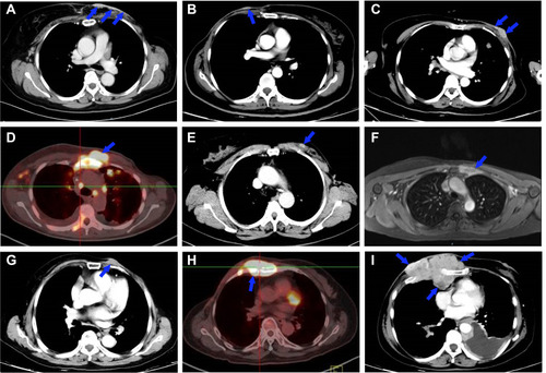 Figure 4 Typical imaging diagnosis examples of CWR for BC. (A–C) Recurrence in skin layer. (D and E) Recurrence in pectoralis layer. (F) Recurrence in rib layer. (G) Recurrence in skin and pectoralis layers; (H) Recurrence in pectoralis and rib layers. (I) Recurrence in skin, pectoralis and rib layers. Blue arrows indicate recurrent chest wall tumor.