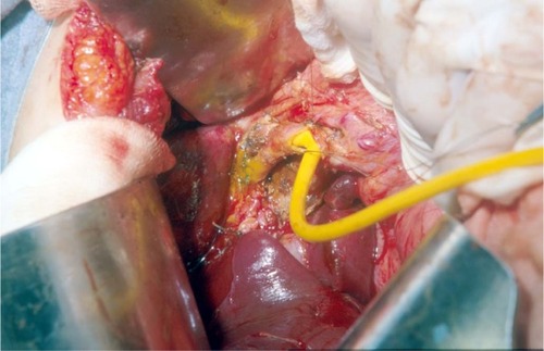 Figure 5 A hepaticojejunostomy was performed for a stricture at biliary confluence after the positioning of T-tube.