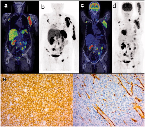Figure 2. 68Ga-DOTANOC PET/CT (a) and maximum intensity projection (MIP) (b) whole body images of a patient with DLBCL of germinal-cell type, showing a large left axillary nodal and upper arm extranodal lesion and multiple other nodal lesions on both sides of the diaphragm. The corresponding FDG PET/CT images (c, d) show a concordant pattern of tracer uptake. IHC of subtype 2 (e) is strongly positive in tumor cells while IHC of subtype 3 (f) shows staining mainly in the endothelial linings of veins.