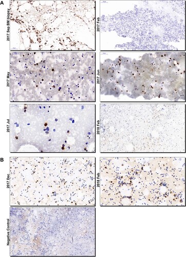Figure 1. Immunohistochemistry analysis of HEV ORF2 proteins in bone marrow smears and biopsy of patients. Photos of bone marrow smears and bone marrow biopsy collected from Patient 1 (A) and 2 (B) were showed. The time of collection was designated on the left side of each photo. Bars, 50 or 100 μm. HEV-specific antibodies (bs-15457r; Bioss, Woburn) were used. The secondary antibody used for staining was goat anti-rabbit IgG (Goodbio Technology, Wuhan). ORF2, open reading frame 2; HEV, hepatitis E virus; BM, bone marrow.
