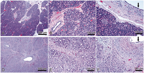 Figure 5. Results of in vivo experiment. Histological images of normal pancreas (A, B, C) and samples with sealing-induced pancreatic atrophy (D, E, F). Compared to normal pancreatic tissue, the treated samples show evident atrophy of the acinar component (purple dye) with only intralobular ducts remaining (D, E); the epithelium of the interlobular ducts is flattened or has been lost (F, black arrow); marked interlobular fibrosis (D, E; F); scattered inflammatory infiltrate (E, F). H&E × 5 (A, D) and ×20 (B, C, E, F).