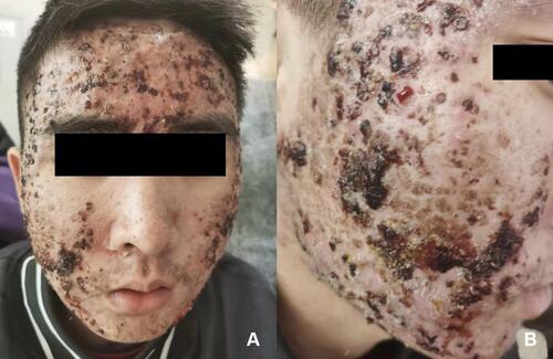 Figure 1 Physical examination showed diffuse papulovesicle and pustules with erosion, exudation, and little scabs on the face which distributed consistent with the treatment site (A and B).