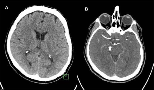 Figure 1 Non contrasted CT (A) and CT-Angiography (B) show a proximal occlusion of the right posterior cerebral artery (PCA) at P1-P2 junction (arrow) without signs for acute ischemic stroke or hemorrhage.