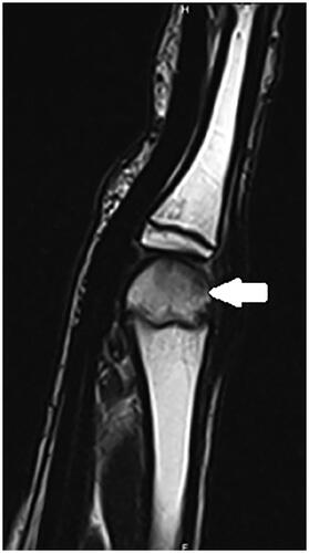 Figure 3. First MRI, July 2022. Subchondral fracture of the distal epiphysis of the third metacarpal head, with probable avascular necrosis and preserved viability in T1 weighted images.