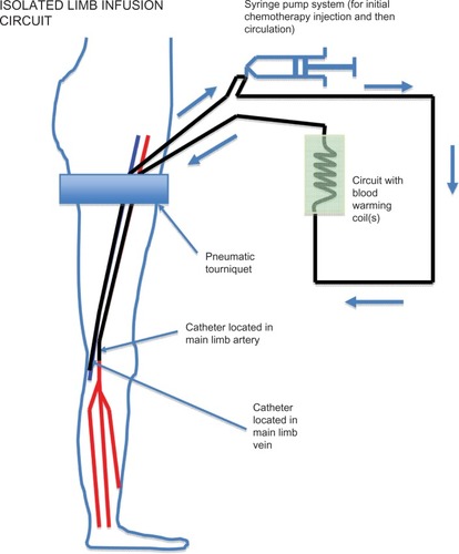 Figure 1 Isolated limb infusion circuit in a lower limb showing positioning of the tourniquet, arterial and venous catheters inserted in the ipsilateral (or contralateral) groin to reach approximately the level of the popliteal artery and vein, respectively, and the extracorporeal warmed circuit using a hand-driven syringe pump.