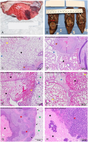 Figure 4. Necropsy photographs (A,B) and H&E histological images (C–H) of swine lungs displaying MWA treatment sites for the three experimental groups. (A) Left caudal lung lobe of a 3-day animal (ID: 9) before formalin fixation showing the treatment site on the pleural surface as a well-demarcated zone of dark red discoloration. (B) Tissue slices after formalin fixation of the right caudal lung lobe of an animal in the Non-Survival (acute) group (ID: 3) subjected to a 5-min ablation (100 W). Within the formalin-fixed lung parenchyma, the lesion is characterized by a central lighter-colored region surrounded by a zone of dark discoloration. The red and white lines indicate the MWA zone’s Length and minimum diameter (Dmin), respectively. A line orthogonal to Length and Dmin represents the maximum diameter (Dmax). (C,D) Low power images (C: 2×; D: 4×) of histological sections of a MWA site (100 W, 3-min) in the right middle lung lobe of a Non-Survival animal (ID:1). The ablation lesion is characterized by an outer zone of hyperemia (yellow star) with an internal region of degeneration/necrosis of the alveolar parenchyma (black stars). There is also degeneration of peribronchial connective tissue (brown stars). Interlobular septa are expanded due to edema (blue stars). (E,F) Low magnification (E: 2×; F: 10×) images of two regions of a MWA site in the left caudal lung lobe of a 3-Day swine (ID: 6) showing areas of coagulative necrosis (black stars), and normal tissue (green stars). The center of the image in panel E shows a region of variable hyperemia, moderate hemorrhage (yellow stars), and disorganized and degenerated alveolar tissue. Interlobular septa in both images are expanded due to edema (blue stars). (G,H) Low (G: 1.25×) and high (H: 20×) power images of a MWA treatment site in the right caudal lung lobe of a 30-Day swine (ID: 14). The low-power image in G displays a central zone of coagulative necrosis (black stars), and a large, circumferential, coalescing granulomatous lesion (red stars). A rim of fibrous tissue (arrows) demarcates the granulomatous lesion from the adjacent, normal lung parenchyma (green stars). The higher power photomicrograph in panel H displays a section of the central zone of coagulative necrosis in the ablation site (black stars), the granulomatous lymphocytic infiltrate adjacent to the necrotic core (red star), and a region of coccoid bacterial colonies (white star), which were detected in the MWA sites of four 30-Day animals.