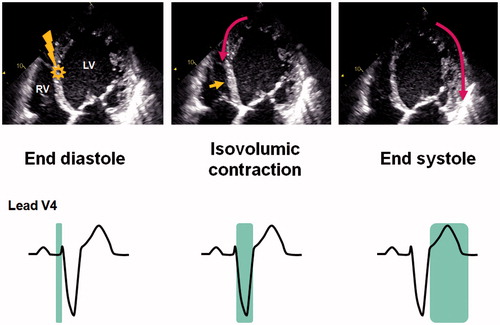 Figure 1. Visual assessment of mechanical dyssynchrony. In patients with left bundle branch block, an early activation of ventricular septum (lightning bolt symbol in the left panel) results in a premature septal contraction (within QRS width) which can be visually appreciated as a short, inward motion (septal flash, yellow arrow in the middle panel). This early septal contraction also causes the apex to move septally. A delayed activation of the posterolateral wall moves the apex laterally while stretching the septum, which can be visually appreciated as apical rocking (Video 1). Modified from Stankovic et al. [Citation11].