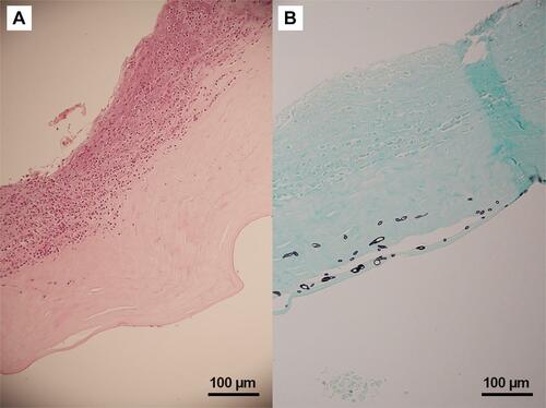 Figure 3 Histopathology of Pythium keratitis in a globe salvage case (Case#19). (A) Histopathology section shows an ulcerated corneal lesion with numerous acute inflammatory cells and necrotic cells primarily located at the anterior stroma (Hematoxylin-Eosin); (B) special stain shows varying sizes of short hyphae at the posterior stroma and pre-Descemet’s membrane area (Gomori Methenamine Silver).