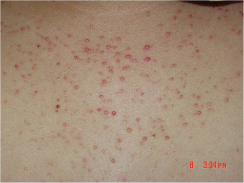 Figure 7. Malassezia folliculitis.