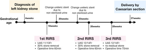 Figure 3 Timeline of kidney stone management.