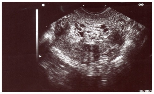 Figure 2 Scan appearance of molar pregnancy on day 27.