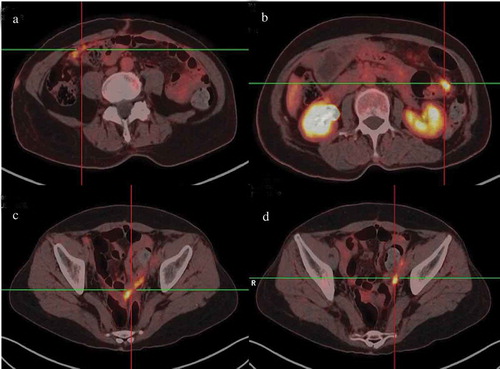 Figure 2. PET-CT showing recurrence and metastasis of malignant mesothelioma. Increased FDG uptake was shown in omentum (a) mesentery (b), pelvic floor (c and d).
