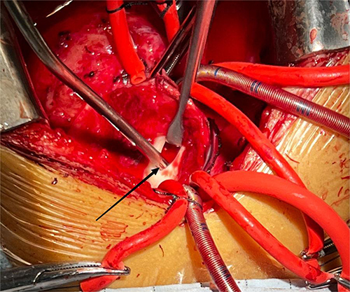 Figure 7 Intraoperative photograph demonstrating the 0.8 cm hole at the base of the pseudoaneurysm. Arrow: rupture site at the base of the pseudoaneurysm.