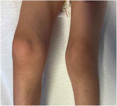Figure 2. Swelling and flexion contracture of the right knee