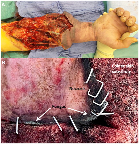 Figure 2. A shows swelling and venous congestion accompanied by necrotic wound areas of the distal forearm 7 days after replantation owing to partially thrombosed arterial and vein grafts. B is a close-up view of necrotic wound edges showing fungus adjacent to the Coldex skin substitute.