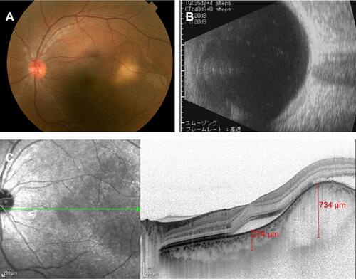 Figure 2 Ocular examination findings in his left eye at the first visit. (A) Fundus photograph shows a white choroidal mass at superior-temporal of the macula. (B) US-B scan showed no evidence of calcification within the mass. (C) EDI-OCT revealed a dome-shaped elevation of the choroid with effacement of the choroidal vessels, and subretinal fluid accumulation. The green arrow shows the location of horizontal section of OCT.